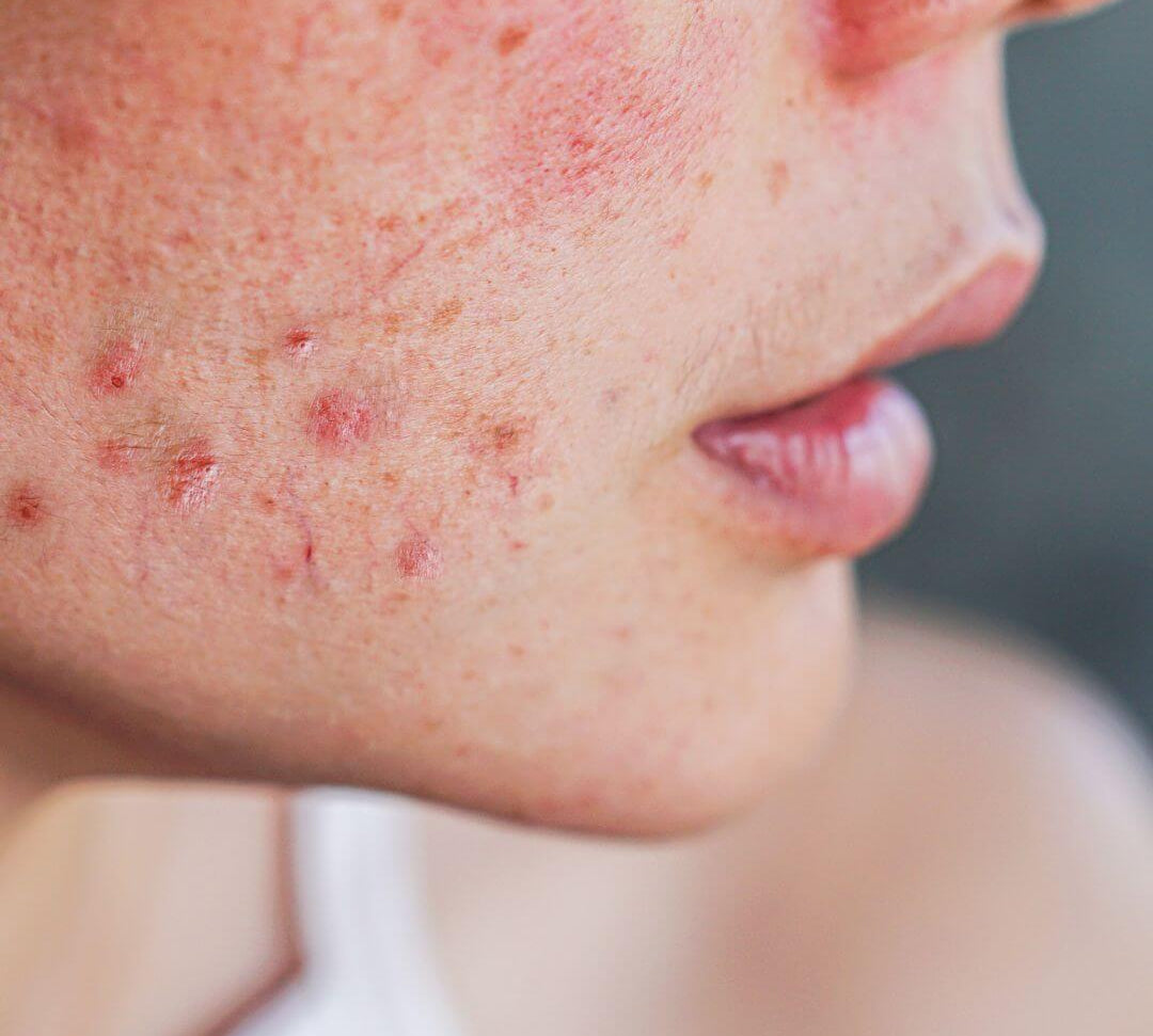 femme avec acné sur le visage