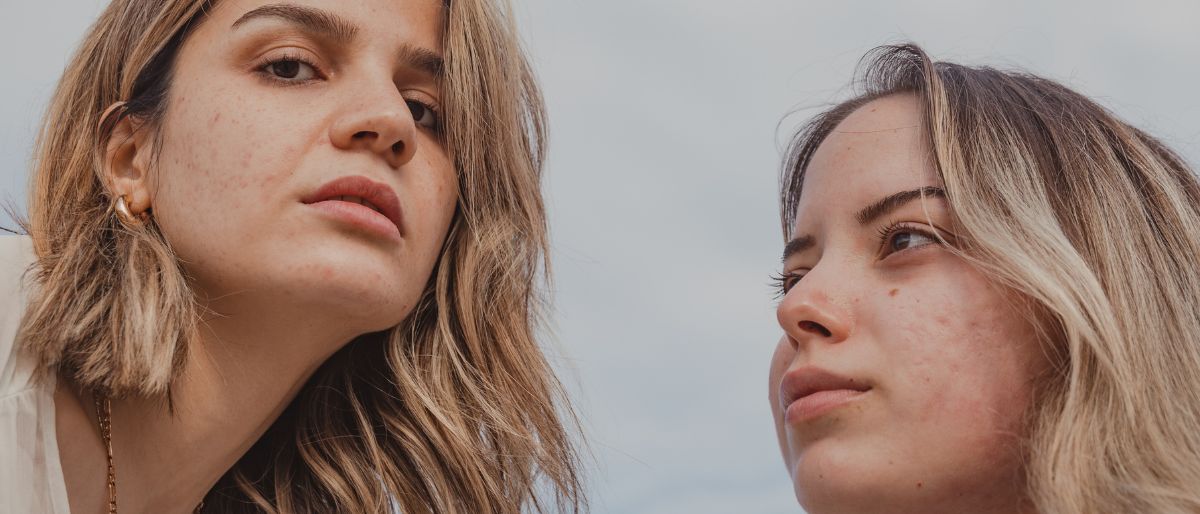 Acné hormonale et alimentation, ce qu'il faut éviter