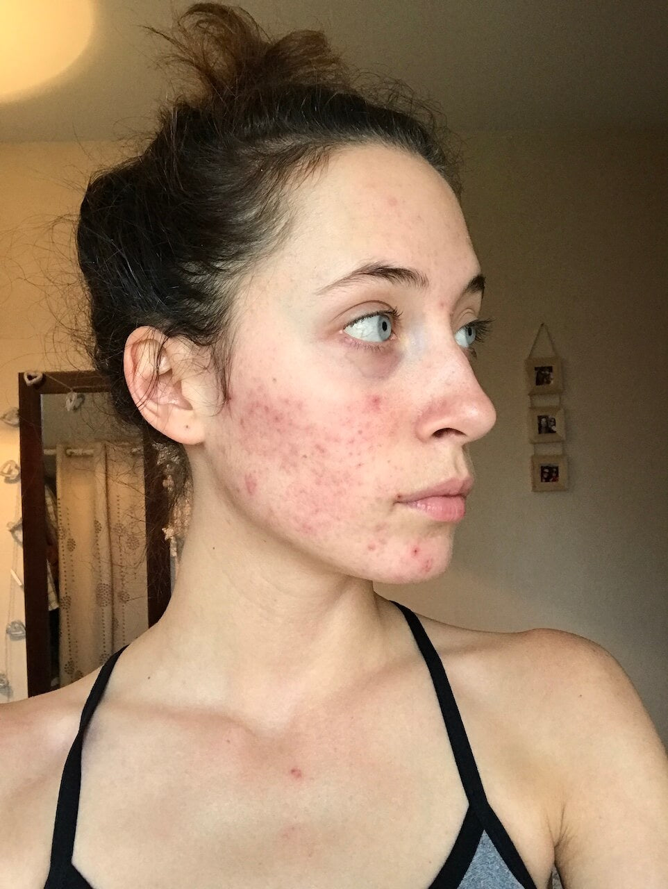 Acne.jpg