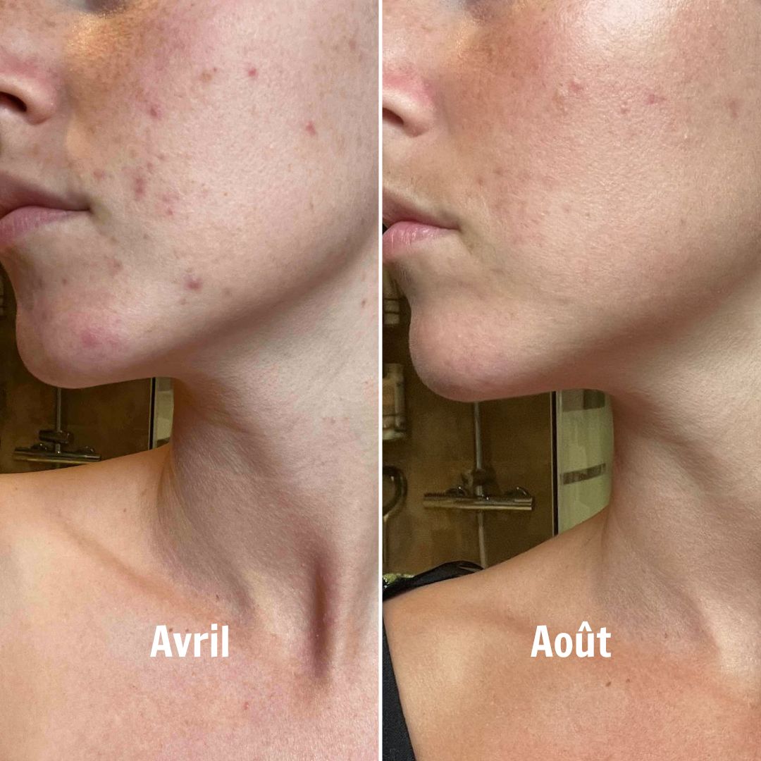 acne-avant-apres-nice-skin-oria-nature.jpg