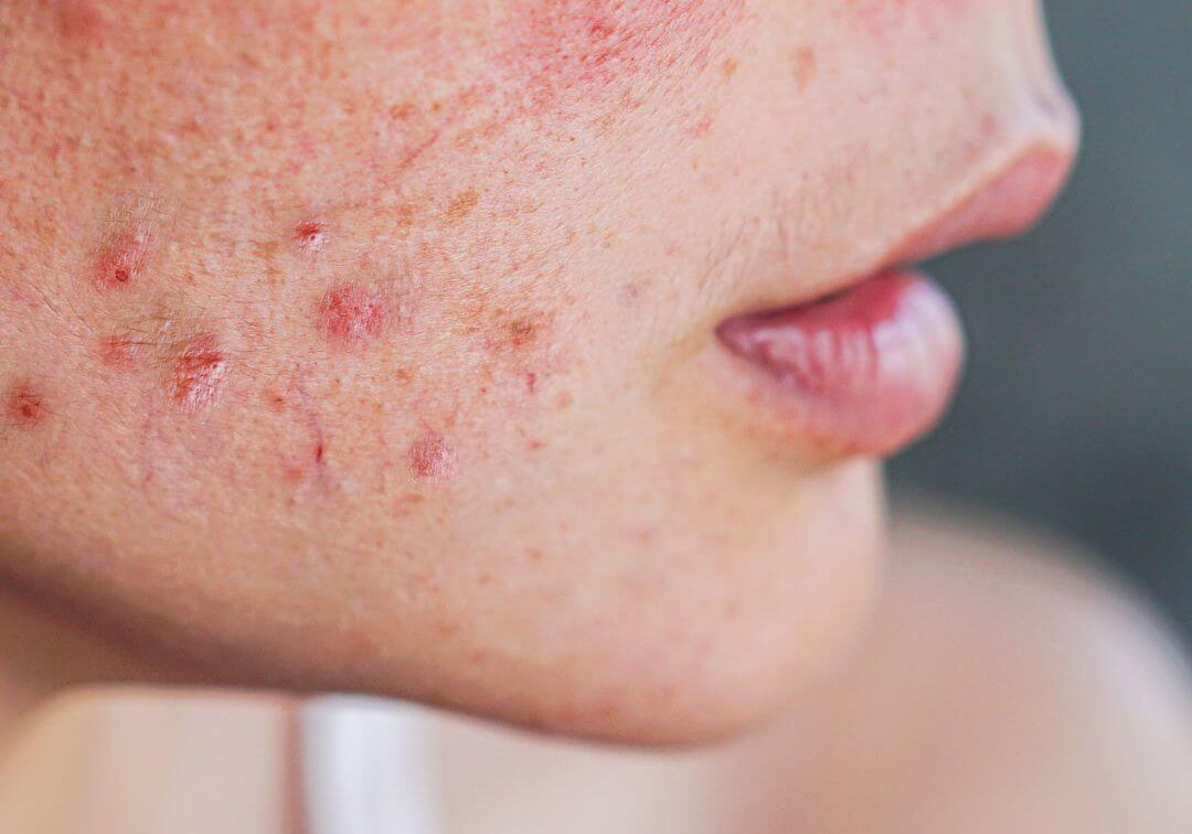 femme avec acné sur le visage