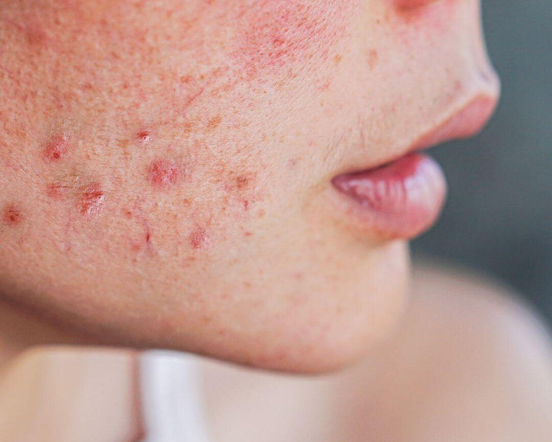 femme avec acné sur le visage