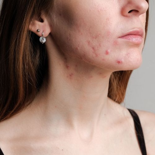 Acné &amp; imperfections