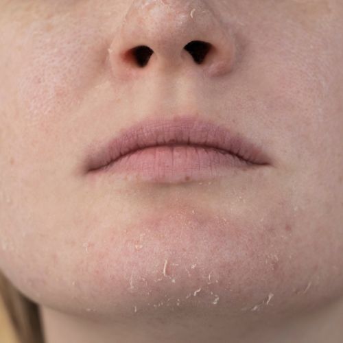 Peau sèche, sécheresse vaginale